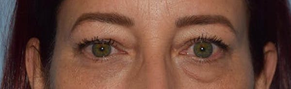 Eyelid Lift Gallery - Patient 14281804 - Image 1