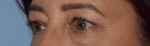 Eyelid Lift Gallery - Patient 14281804 - Image 3