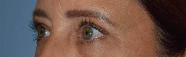 Eyelid Lift Before & After Gallery - Patient 14281804 - Image 4