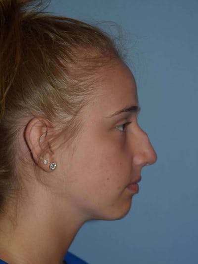 Rhinoplasty Before & After Gallery - Patient 14281859 - Image 1