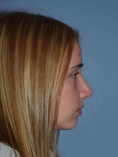 Rhinoplasty Before & After Gallery - Patient 14281859 - Image 2