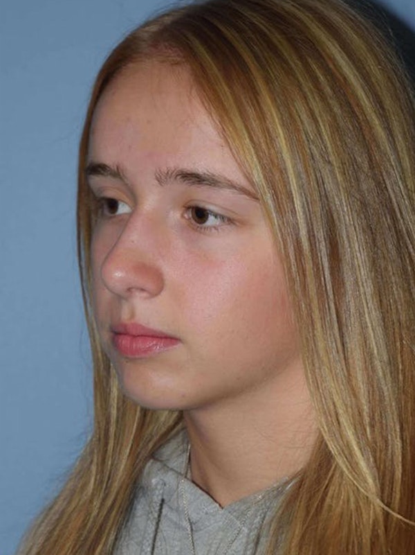 Rhinoplasty Before & After Gallery - Patient 14281859 - Image 4