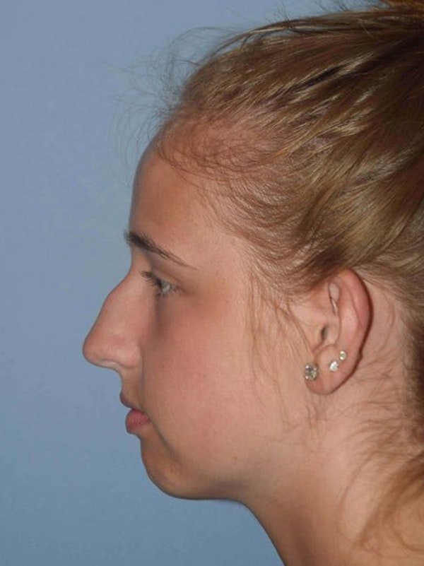 Rhinoplasty Before & After Gallery - Patient 14281859 - Image 5
