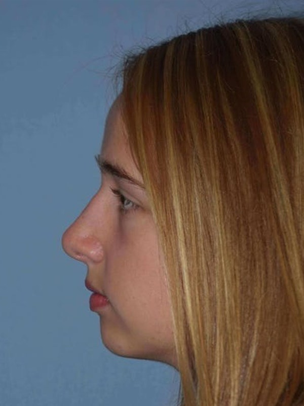 Rhinoplasty Before & After Gallery - Patient 14281859 - Image 6