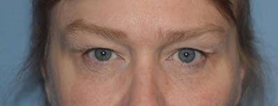 Eyelid Lift Before & After Gallery - Patient 14281795 - Image 1