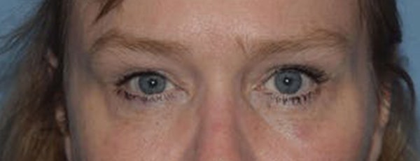 Eyelid Lift Before & After Gallery - Patient 14281795 - Image 2