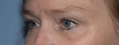 Eyelid Lift Before & After Gallery - Patient 14281795 - Image 4