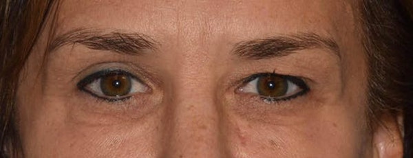 Eyelid Lift Before & After Gallery - Patient 14281796 - Image 1