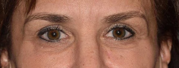 Eyelid Lift Before & After Gallery - Patient 14281796 - Image 2