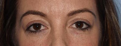 Eyelid Lift Before & After Gallery - Patient 14281798 - Image 1