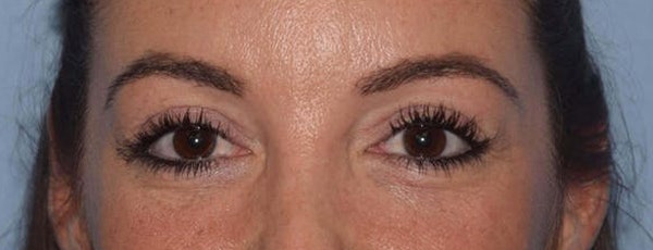 Eyelid Lift Before & After Gallery - Patient 14281798 - Image 2