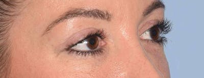 Eyelid Lift Before & After Gallery - Patient 14281798 - Image 4