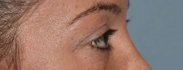 Eyelid Lift Before & After Gallery - Patient 14281798 - Image 5