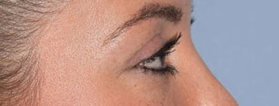 Eyelid Lift Before & After Gallery - Patient 14281798 - Image 6