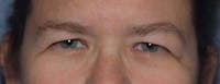 Eyelid Lift Before & After Gallery - Patient 14281799 - Image 1