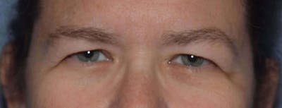 Eyelid Lift Before & After Gallery - Patient 14281799 - Image 1
