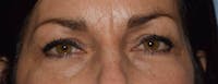 Eyelid Lift Before & After Gallery - Patient 14281800 - Image 1