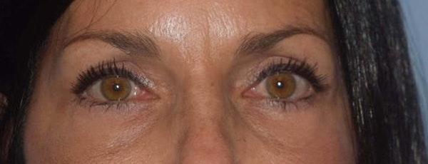 Eyelid Lift Before & After Gallery - Patient 14281800 - Image 2