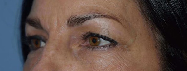 Eyelid Lift Before & After Gallery - Patient 14281800 - Image 3