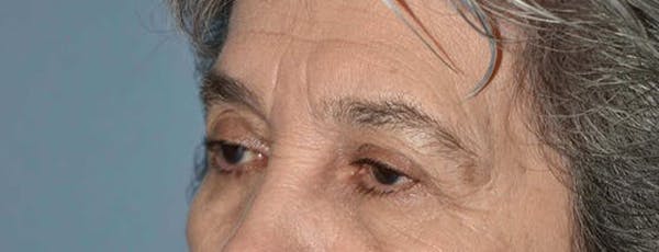 Eyelid Lift Gallery - Patient 14281802 - Image 3