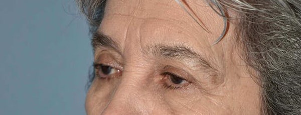 Eyelid Lift Before & After Gallery - Patient 14281802 - Image 1