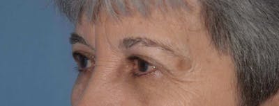 Eyelid Lift Before & After Gallery - Patient 14281802 - Image 2