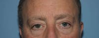 Eyelid Lift Gallery - Patient 14281803 - Image 1