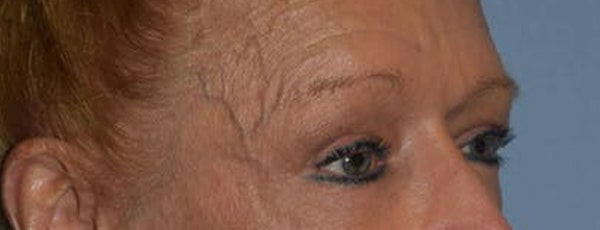 Eyelid Lift Before & After Gallery - Patient 14281805 - Image 4