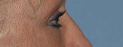 Eyelid Lift Before & After Gallery - Patient 14281805 - Image 6