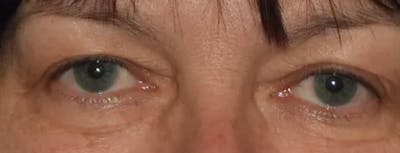 Eyelid Lift Gallery - Patient 14281811 - Image 1