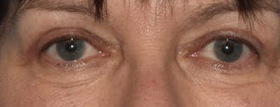 Eyelid Lift Before & After Gallery - Patient 14281811 - Image 2