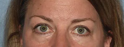 Eyelid Lift Gallery - Patient 17337874 - Image 1