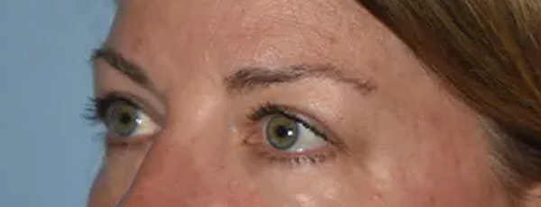 Eyelid Lift Before & After Gallery - Patient 17337874 - Image 3