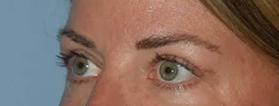 Eyelid Lift Before & After Gallery - Patient 17337874 - Image 4
