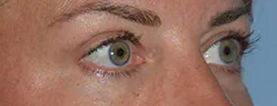 Eyelid Lift Before & After Gallery - Patient 17337874 - Image 8