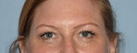 Eyelid Lift Before & After Gallery - Patient 17337875 - Image 1