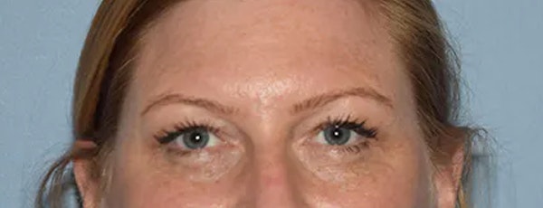 Eyelid Lift Before & After Gallery - Patient 17337875 - Image 1