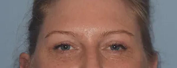 Eyelid Lift Gallery - Patient 17337875 - Image 2