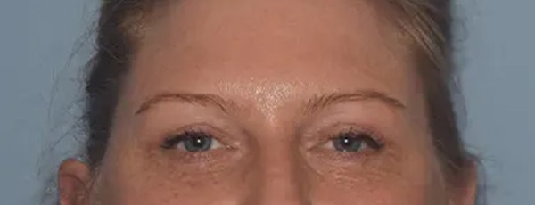 Eyelid Lift Before & After Gallery - Patient 17337875 - Image 2