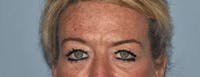 Eyelid Lift Before & After Gallery - Patient 17337876 - Image 1