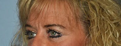 Eyelid Lift Before & After Gallery - Patient 17337876 - Image 4