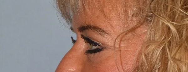 Eyelid Lift Before & After Gallery - Patient 17337876 - Image 6