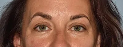 Eyelid Lift Before & After Gallery - Patient 17338158 - Image 1