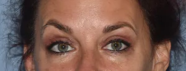 Eyelid Lift Before & After Gallery - Patient 17338158 - Image 2