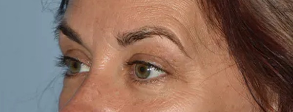 Eyelid Lift Before & After Gallery - Patient 17338158 - Image 3