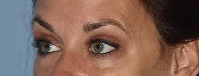 Eyelid Lift Before & After Gallery - Patient 17338158 - Image 4