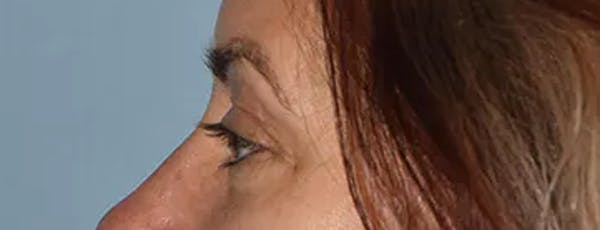 Eyelid Lift Before & After Gallery - Patient 17338158 - Image 5