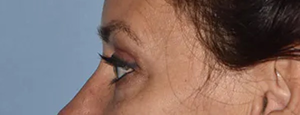 Eyelid Lift Before & After Gallery - Patient 17338158 - Image 6