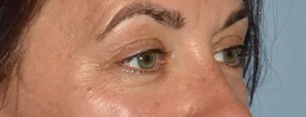 Eyelid Lift Before & After Gallery - Patient 17338158 - Image 7