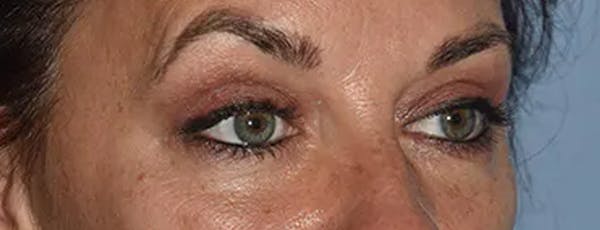 Eyelid Lift Before & After Gallery - Patient 17338158 - Image 8